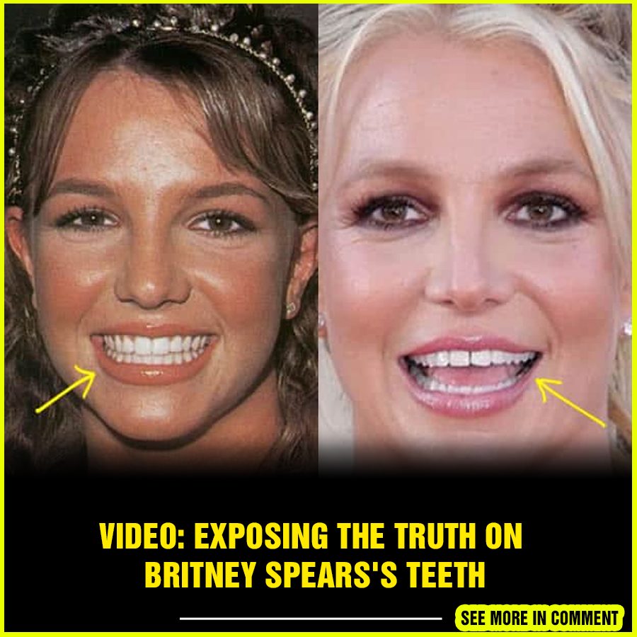 VIDEO Exposing the Truth on Britney Spearss Teeth